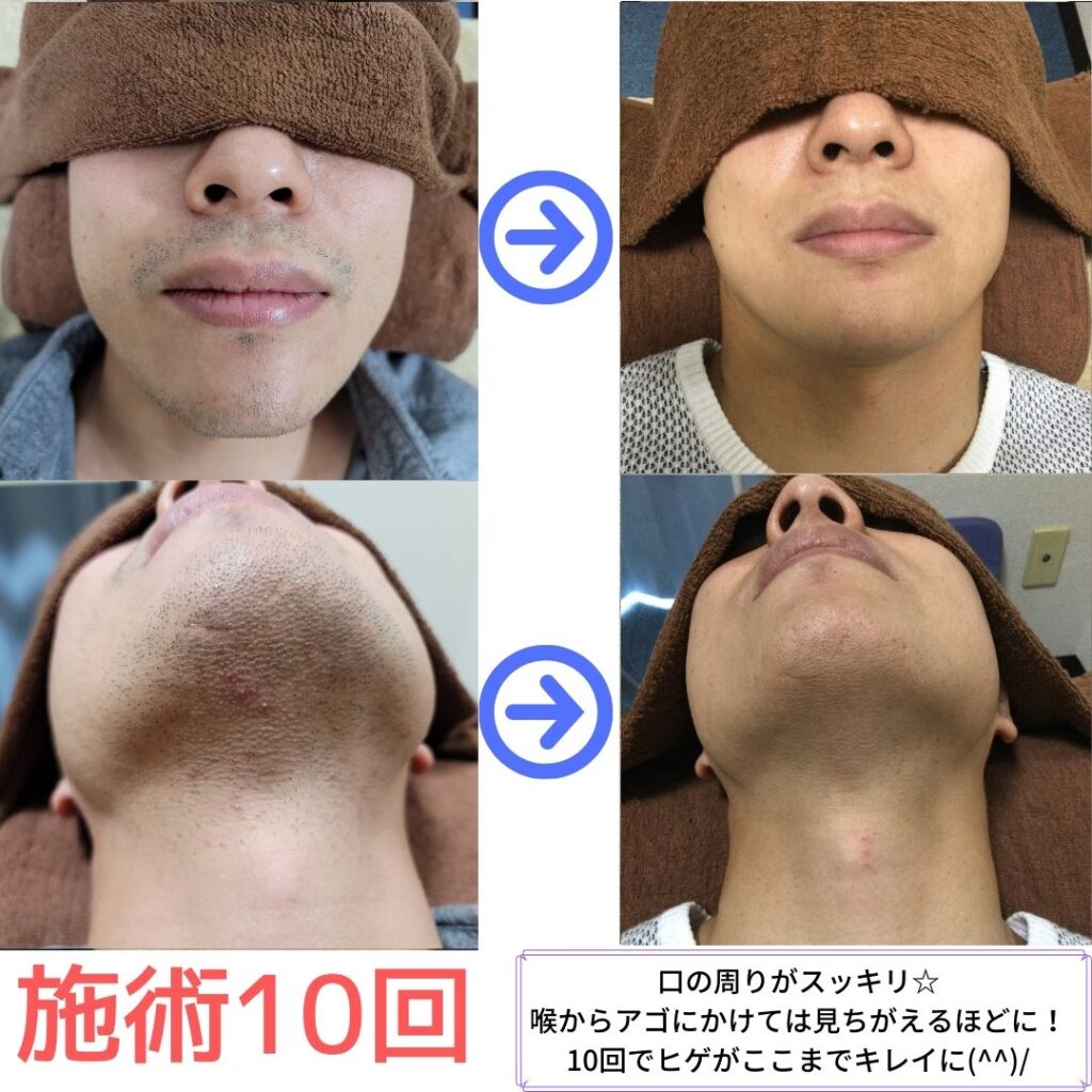 ヒゲ脱毛の変化